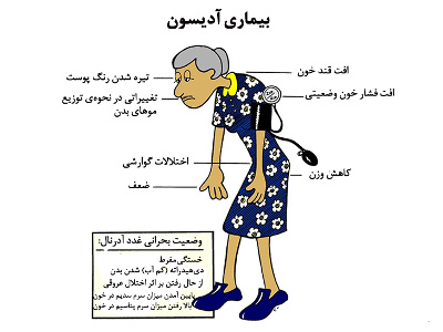 درمان گیاهی بیماری ادیسون