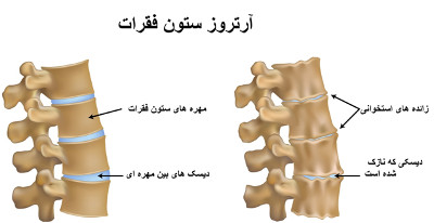 درمان آرتروز ستون فقرات