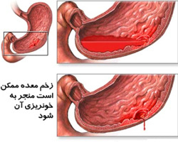 خونریزی دستگاه گوارشی